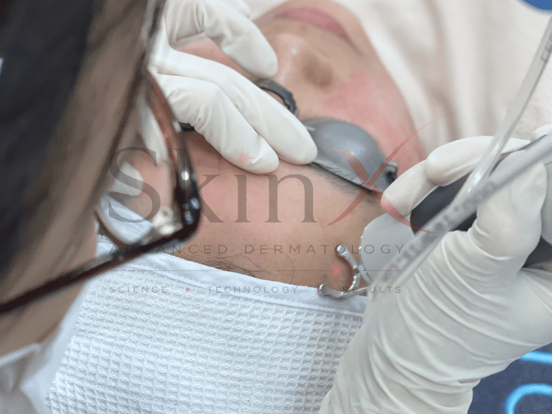Không chỉ dừng ở cải thiện mụn, sẹo mà còn giúp làn da trẻ hóa hiệu quả 